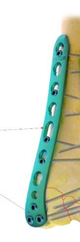 Дистальна латеральна плечова пластина ліва( Double Medical Technology Inc.)